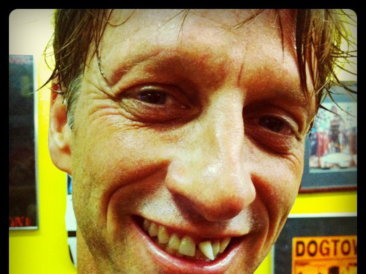 Tony Hawk skončil so zlomeným zubom