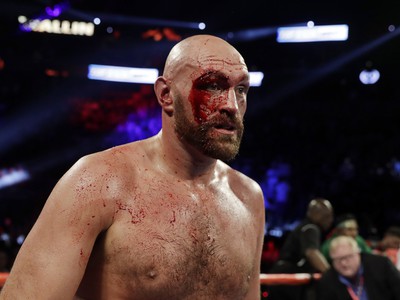 Tyson Fury to zvládol aj napriek krvavému zraneniu nad okom