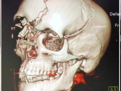 Štúdiá, na ktorej vidno, ako mala de Villotová po nehode zničenú lebku