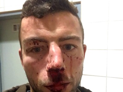 Michal Hlinka skončil po napadnutí s krvavými zraneniami