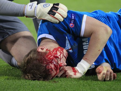 Tomáš Hubočan s krvavou tvárou po nepríjemnom zranení